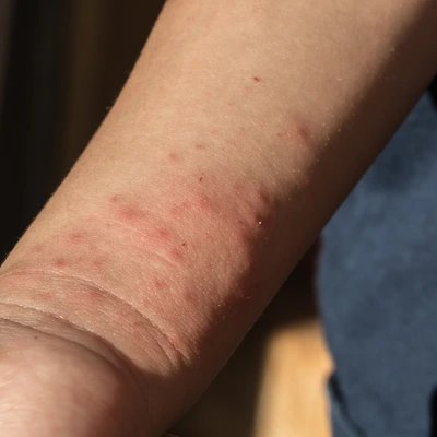 Укуси клопів